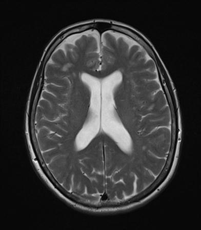 File:Base of skull chondrosarcoma (Radiopaedia 30410-31070 Axial T2 13).jpg