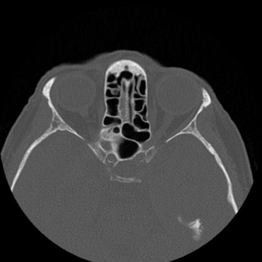 File:Base of skull chondrosarcoma (Radiopaedia 30410-31071 Axial bone window 29).jpg