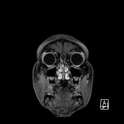 Base of skull rhabdomyosarcoma (Radiopaedia 32196-33142 I 17).jpg