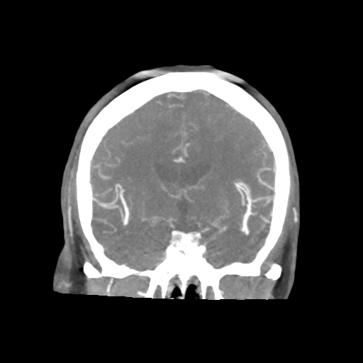Basilar and bilateral vertebral artery occlusion (Radiopaedia 45592-49723 B 47).png