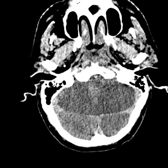 Basilar artery thrombosis (Radiopaedia 53351-59352 Axial non-contrast 31).jpg