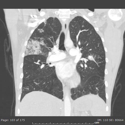 Behçet disease (Radiopaedia 44247-47889 Coronal lung window 31).jpg