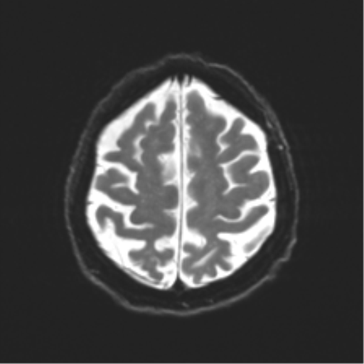Behavioral variant frontotemporal dementia and late onset schizophrenia (Radiopaedia 52197-58083 Axial DTI Trace W 21).png