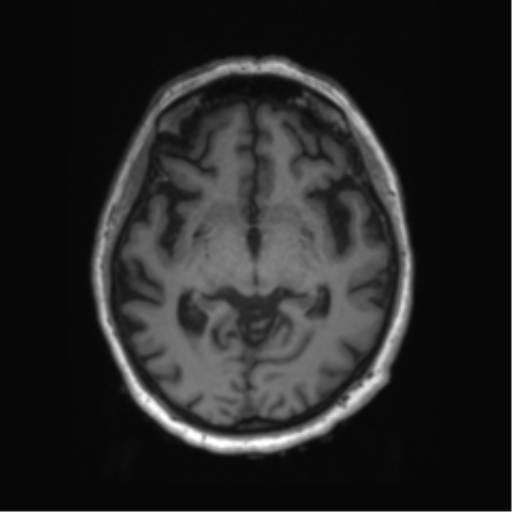 Behavioral variant frontotemporal dementia and late onset schizophrenia (Radiopaedia 52197-58083 Axial T1 58).png