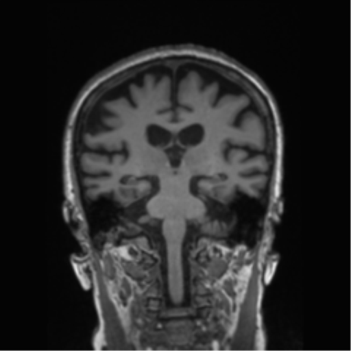 Behavioral variant frontotemporal dementia and late onset schizophrenia (Radiopaedia 52197-58083 Coronal T1 43).png