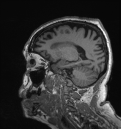 File:Behavioral variant frontotemporal dementia and late onset schizophrenia (Radiopaedia 52197-58083 Sagittal T1 69).png
