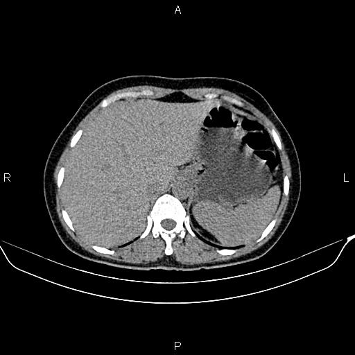 Benign adrenal adenoma (Radiopaedia 84166-99440 Axial non-contrast 18).jpg