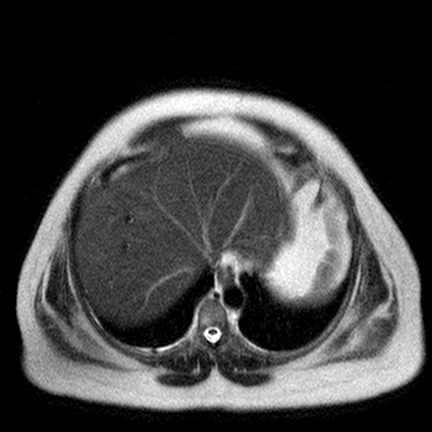 File:Benign seromucinous cystadenoma of the ovary (Radiopaedia 71065-81300 Axial T2 20).jpg