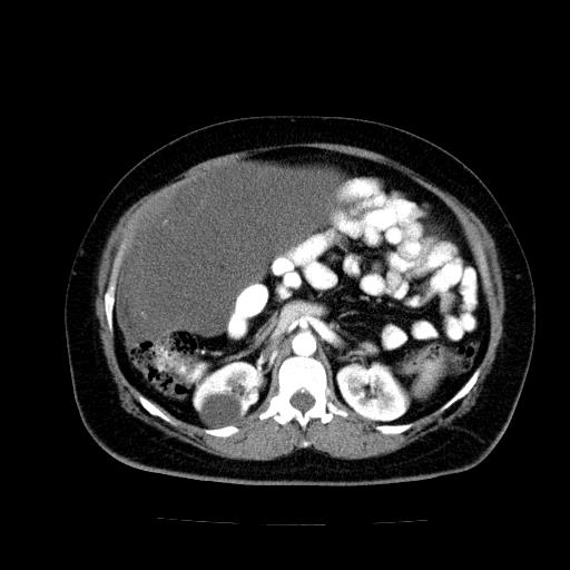 Benign spindle cell tumor - abdominopelvic (Radiopaedia 61300-69212 A 24).jpg