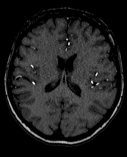 Berry aneurysm of the terminal internal carotid artery (Radiopaedia 88286-104918 Axial TOF 145).jpg