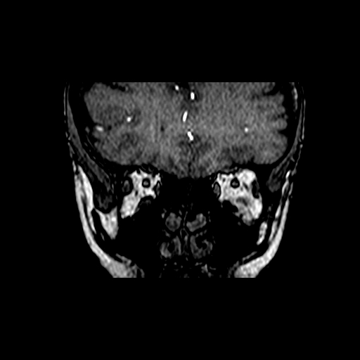 Berry aneurysm of the terminal internal carotid artery (Radiopaedia 88286-104918 Coronal TOF 9).jpg