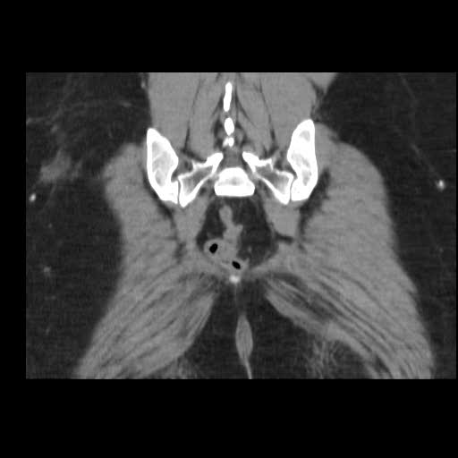File:Bicornuate uterus (MRI) (Radiopaedia 49206-54296 Coronal 18).jpg