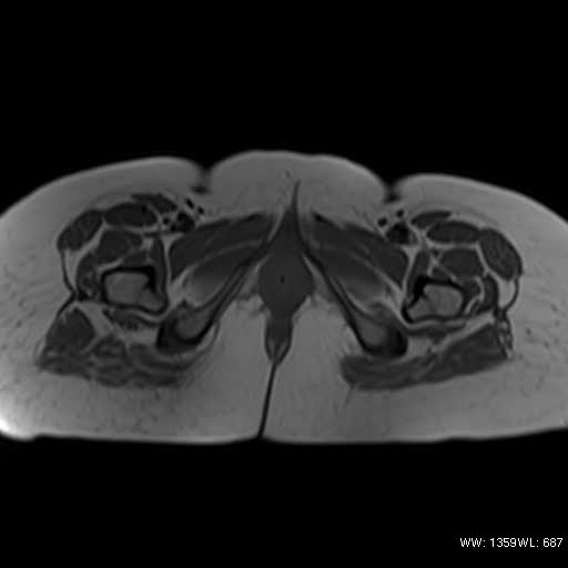 File:Bicornuate uterus (MRI) (Radiopaedia 49206-54297 Axial 12).jpg
