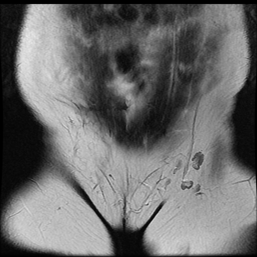 File:Bicornuate uterus (Radiopaedia 51676-57472 Coronal T2 4).jpg