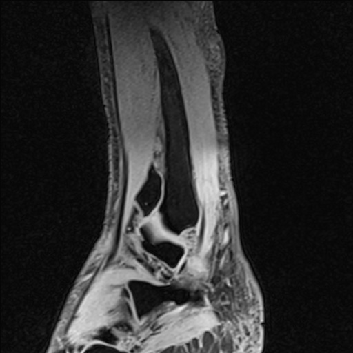 File:Bilateral Achilles tendon complete tear (Radiopaedia 81344-95051 Sagittal WE - Left 87).jpg