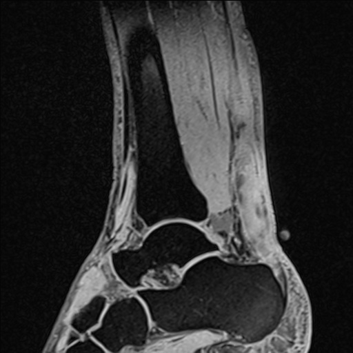 Bilateral Achilles tendon complete tear (Radiopaedia 81344-95051 Sagittal WE - Right 52).jpg