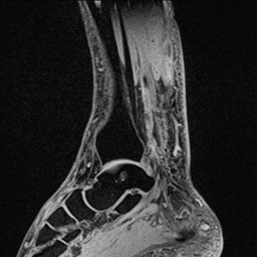 Bilateral Achilles tendon complete tear (Radiopaedia 81344-95051 Sagittal WE - Right 72).jpg