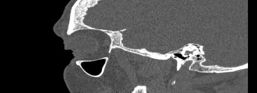 Bilateral Ectopic Infraorbital Nerves (Radiopaedia 49006-54084 Sagittal bone window 48).jpg