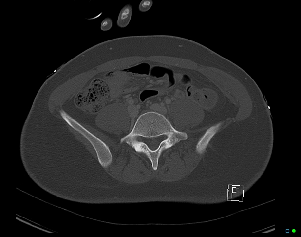 File:Bilateral acetabular fractures (Radiopaedia 79272-92308 Axial bone window 9).jpg