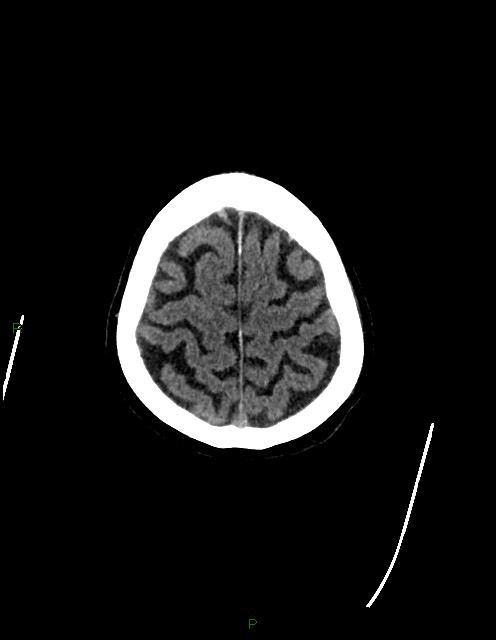 Bilateral acute middle cerebral artery territory infarcts (Radiopaedia 77319-89401 Axial non-contrast 78).jpg