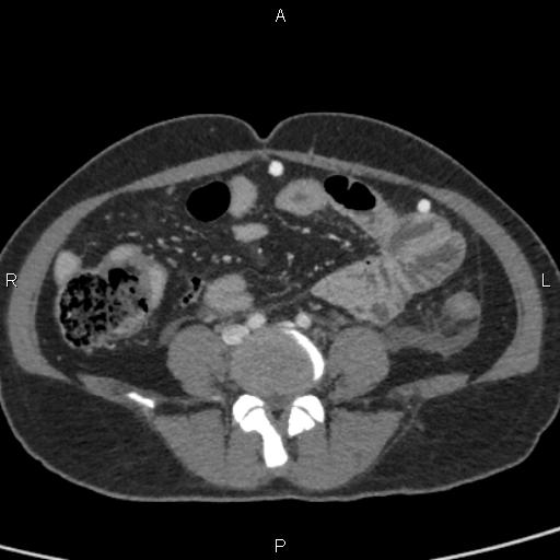 Bilateral adrenal gland hyperenhancement in pancreatitis (Radiopaedia 86642-102753 E 74).jpg
