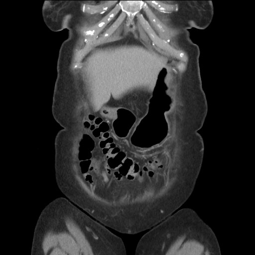 Bilateral adrenal granulocytic sarcomas (chloromas) (Radiopaedia 78375-91007 B 21).jpg