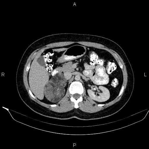 Bilateral adrenal myelolipoma (Radiopaedia 63058-71535 Axial C+ delayed 39).jpg