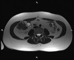 File:Bilateral adrenal myelolipoma (Radiopaedia 63058-71537 Axial T2 26).jpg