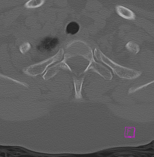 File:Bilateral atlanto-occipital assimilation (Radiopaedia 28350-28603 Axial bone window 44).jpg