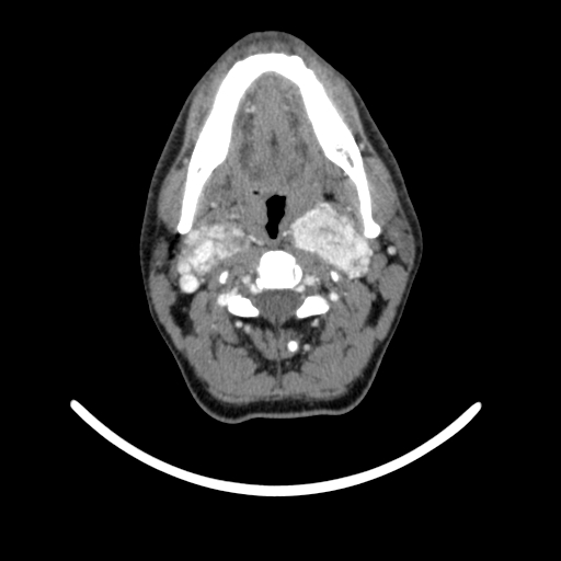 Bilateral carotid body tumors (Radiopaedia 52899-58827 A 23).jpg