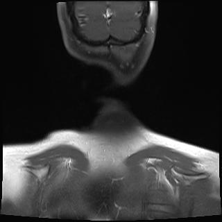 File:Bilateral carotid body tumors and right jugular paraganglioma (Radiopaedia 20024-20060 None 23).jpg