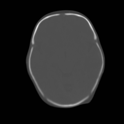 File:Bilateral cephalohematomas and subdural hematomas (Radiopaedia 26778-26929 Axial bone window 9).jpg