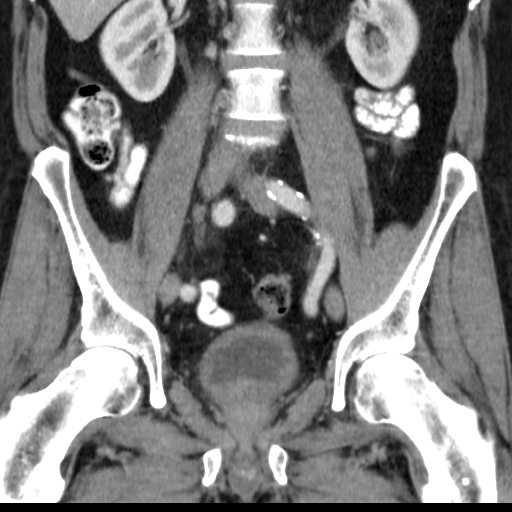 File:Bilateral direct inguinal herniae (Radiopaedia 17016-16719 A 22).jpg