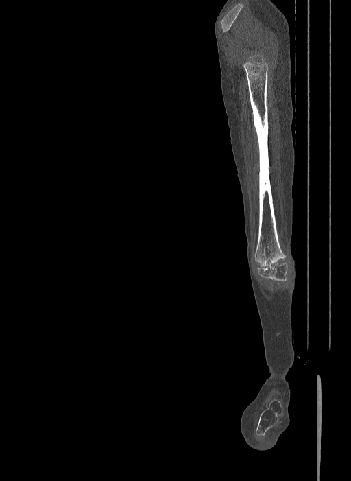 Bilateral fibular hemimelia type II (Radiopaedia 69581-79491 Sagittal bone window 23).jpg