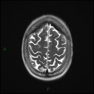 File:Bilateral frontal mucoceles (Radiopaedia 82352-96455 Axial T2 18).jpg