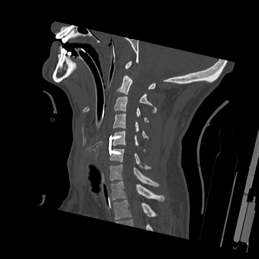 Bilateral locked facets (Radiopaedia 33850-35023 Sagittal bone window 27).png