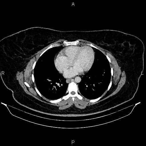 Bilateral ovarian dermoid cysts (Radiopaedia 85785-101603 A 6).jpg