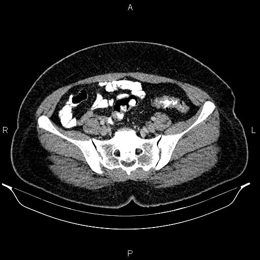 Bilateral ovarian dermoid cysts (Radiopaedia 85785-101603 A 81).jpg