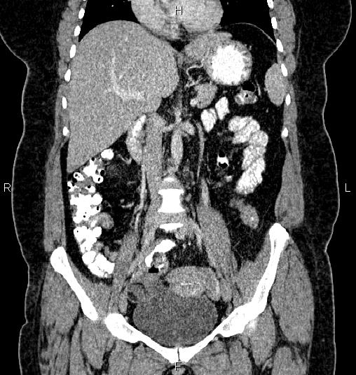 Bilateral ovarian dermoid cysts (Radiopaedia 85785-101603 C 25).jpg
