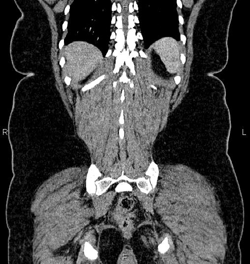File:Bilateral ovarian dermoid cysts (Radiopaedia 85785-101603 C 52).jpg