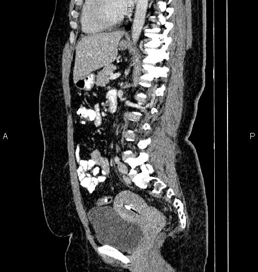 File:Bilateral ovarian dermoid cysts (Radiopaedia 85785-101603 D 53).jpg