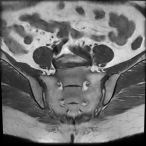 File:Bilateral ovarian dermoid cysts (Radiopaedia 90152-107338 Axial T1 3).jpg