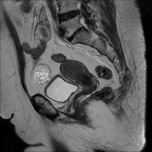 File:Bilateral ovarian dermoid cysts (Radiopaedia 90152-107338 Sagittal T2 15).jpg
