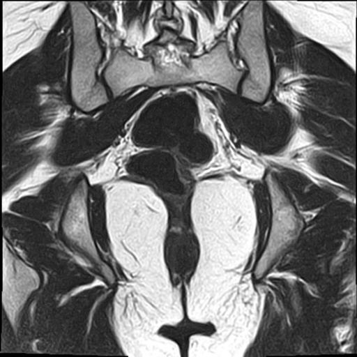 File:Bilateral ovarian endometriomas (Radiopaedia 87085-103347 Coronal T2 17).jpg