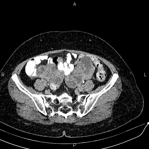File:Bilateral ovarian serous cystadenocarcinoma (Radiopaedia 86062-101989 Axial C+ delayed 59).jpg