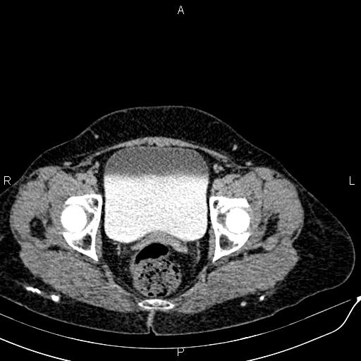 File:Bilateral ovarian serous cystadenocarcinoma (Radiopaedia 86062-101989 Axial C+ delayed 75).jpg