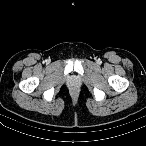 Bilateral ovarian teratoma (Radiopaedia 83131-97503 Axial With contrast 83).jpg