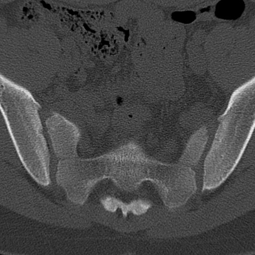 Bilateral pars defect (Radiopaedia 26691-26846 Axial bone window 102).jpg