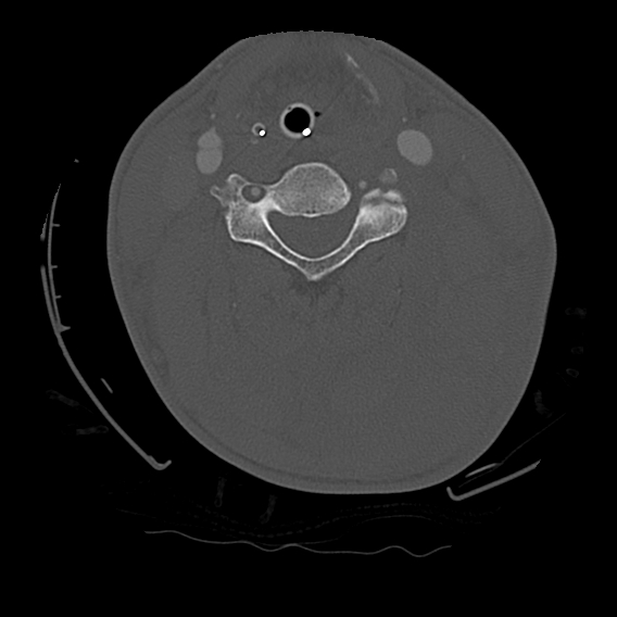 File:Bilateral perched facets with cord injury (Radiopaedia 45587-49713 Axial bone window 58).jpg