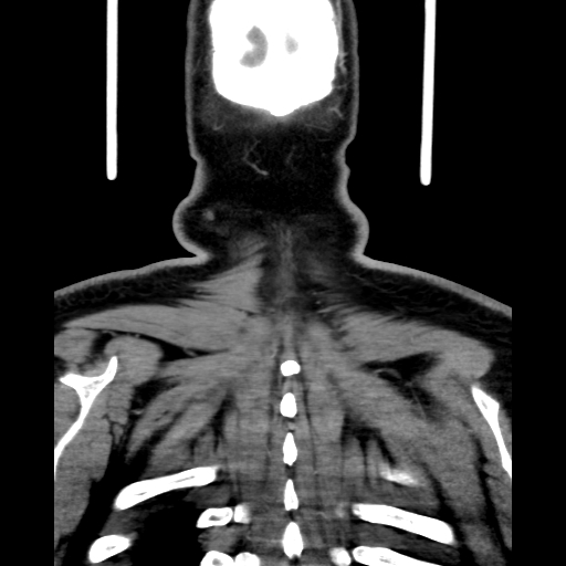 Bilateral peritonsillar abscess (Radiopaedia 85065-100610 Coronal 70).jpg